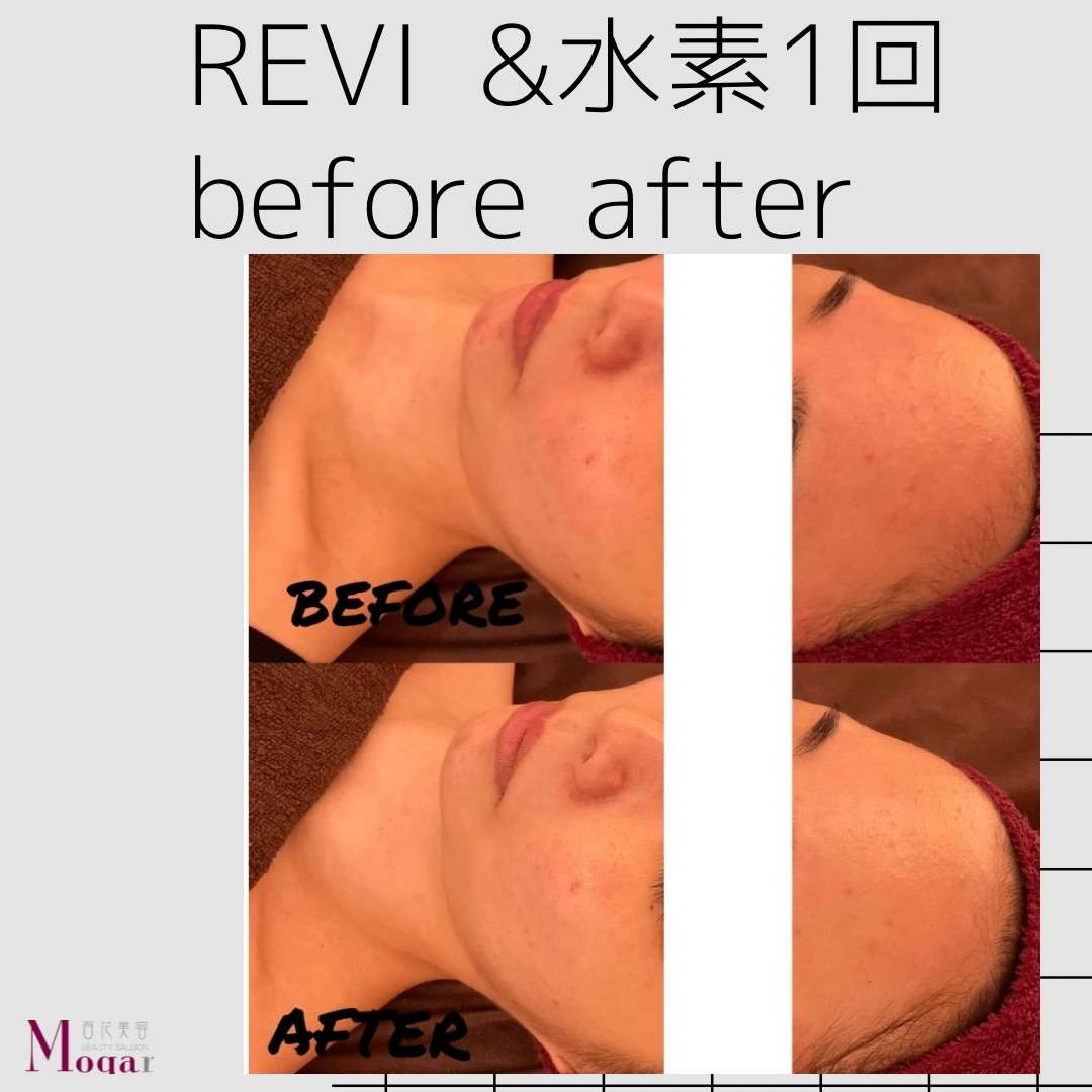 【心斎橋エステ】REVI&水素BeforeAfter