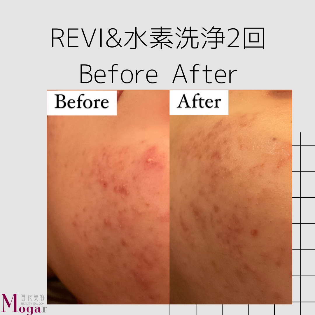 【心斎橋 エステ 肌質改善】REVI&ハイドロフェイシャルBeforeAfter